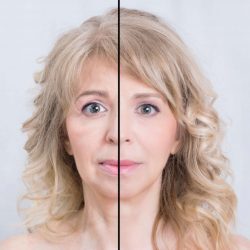 biyolojik lifting aşısı biyolojik lifting aşısı